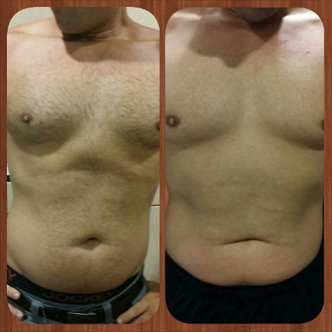 cavitation before after ultrasonic fat reduction