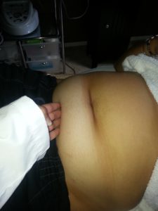 before ultrasonic fat cavitation