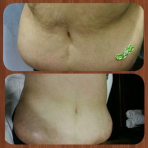 Ultrasonic Cavitation Reduces Fat