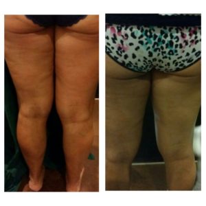 Radio frequency skin tighening treatments in South Tampa