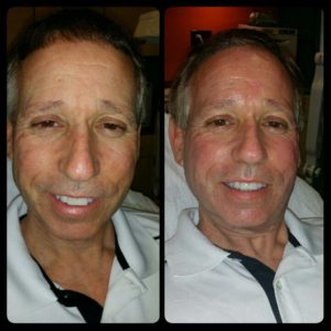 microdermabrasion before and after tampa