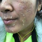 chemical peel with powerful peeling action