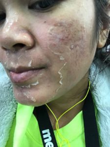 chemical peel with powerful peeling action