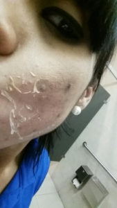 chemical peel acne hyper-pigmentation