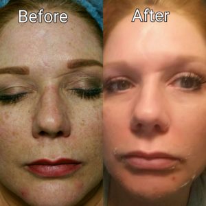 image perfection lift removed acne and freckles