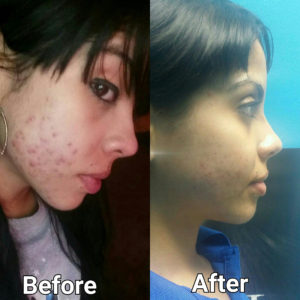 acne peel in tampa