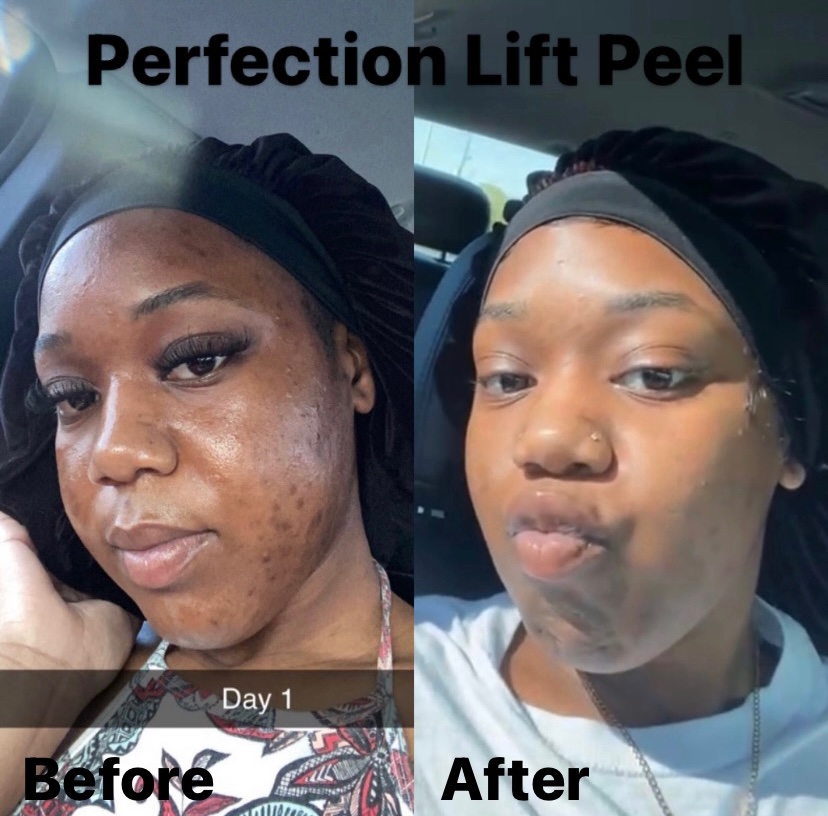 perfection lift amazing results