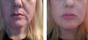 facial skin tightening treatments
