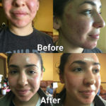 acne facial peel before and after