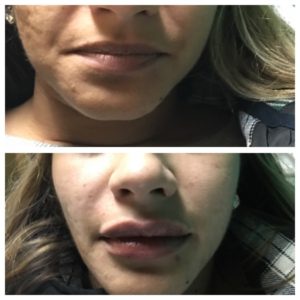 botox for beautiful full lips