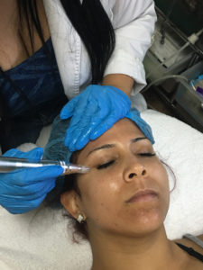 microneedling services in tampa