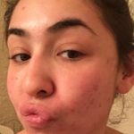 microneedling for acne a week later
