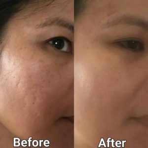 microneedling before and after tampa