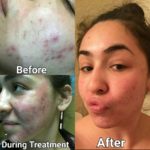microneedling before and after for acne
