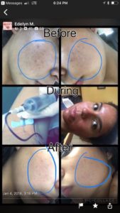 prp facial before and after