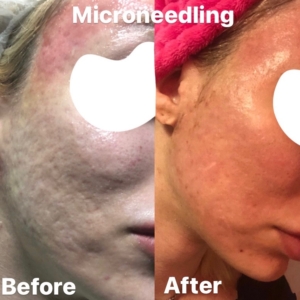 microneedling in tampa fantastic results