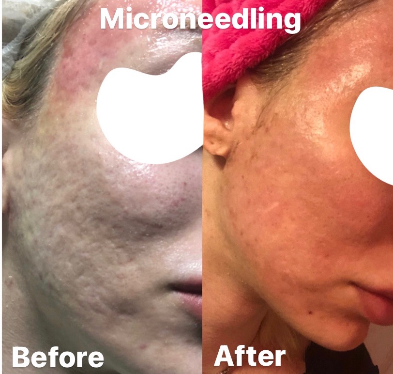 microneedling in tampa fantastic results