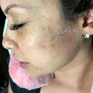 tampa spa dermaplaning for exfoliation