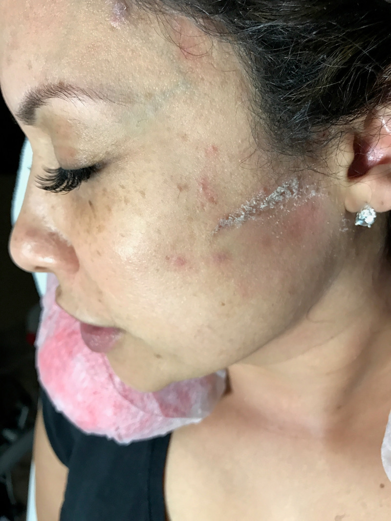 tampa spa dermaplaning for exfoliation