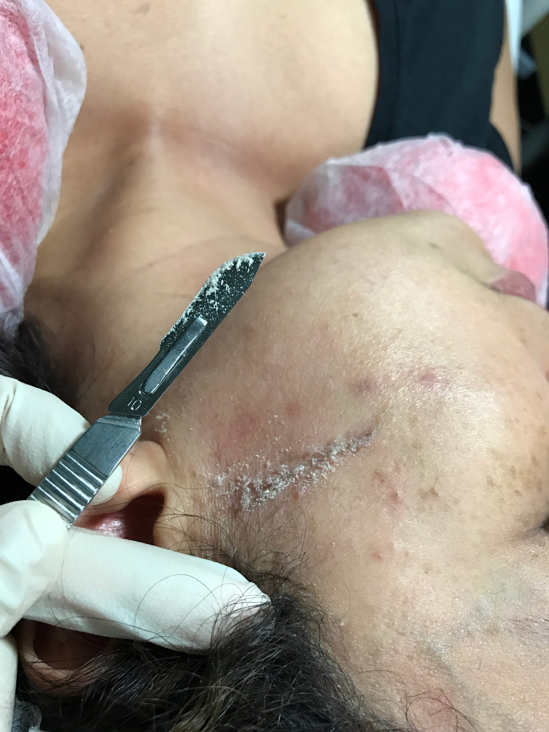 tampa spa dermaplaning treatments