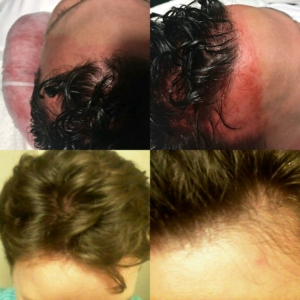 prp for hair loss before and after