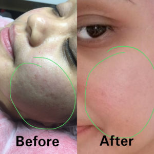 PRP Facial Rejuvenation Tampa