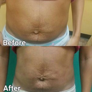 laser lipo before and after