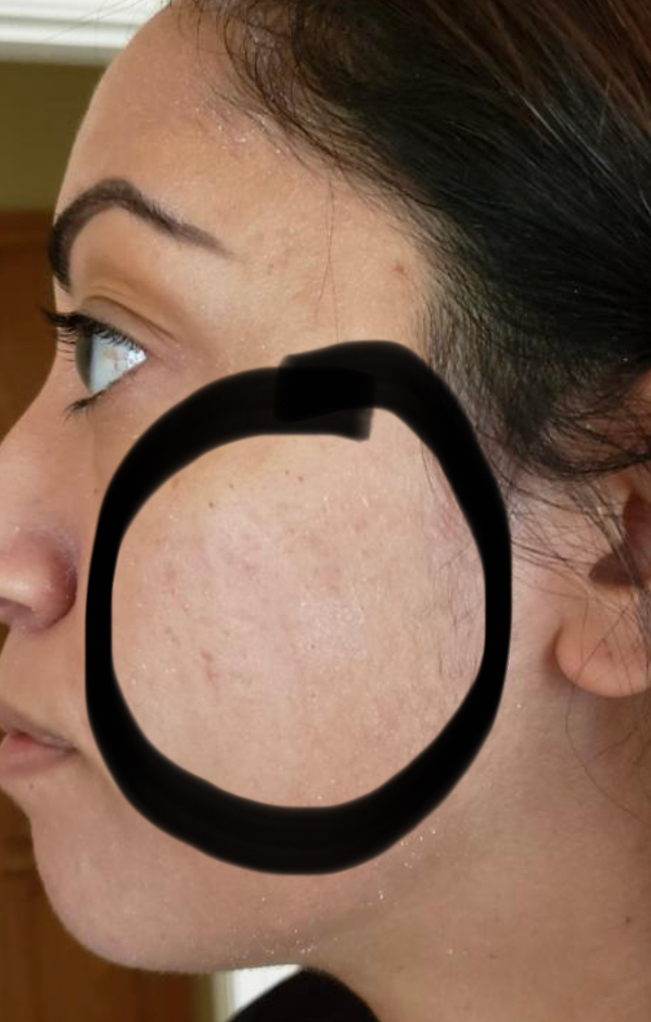 microneedling after