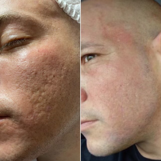 RF Microneedling