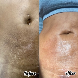 rf microneedling on stomach in tampa