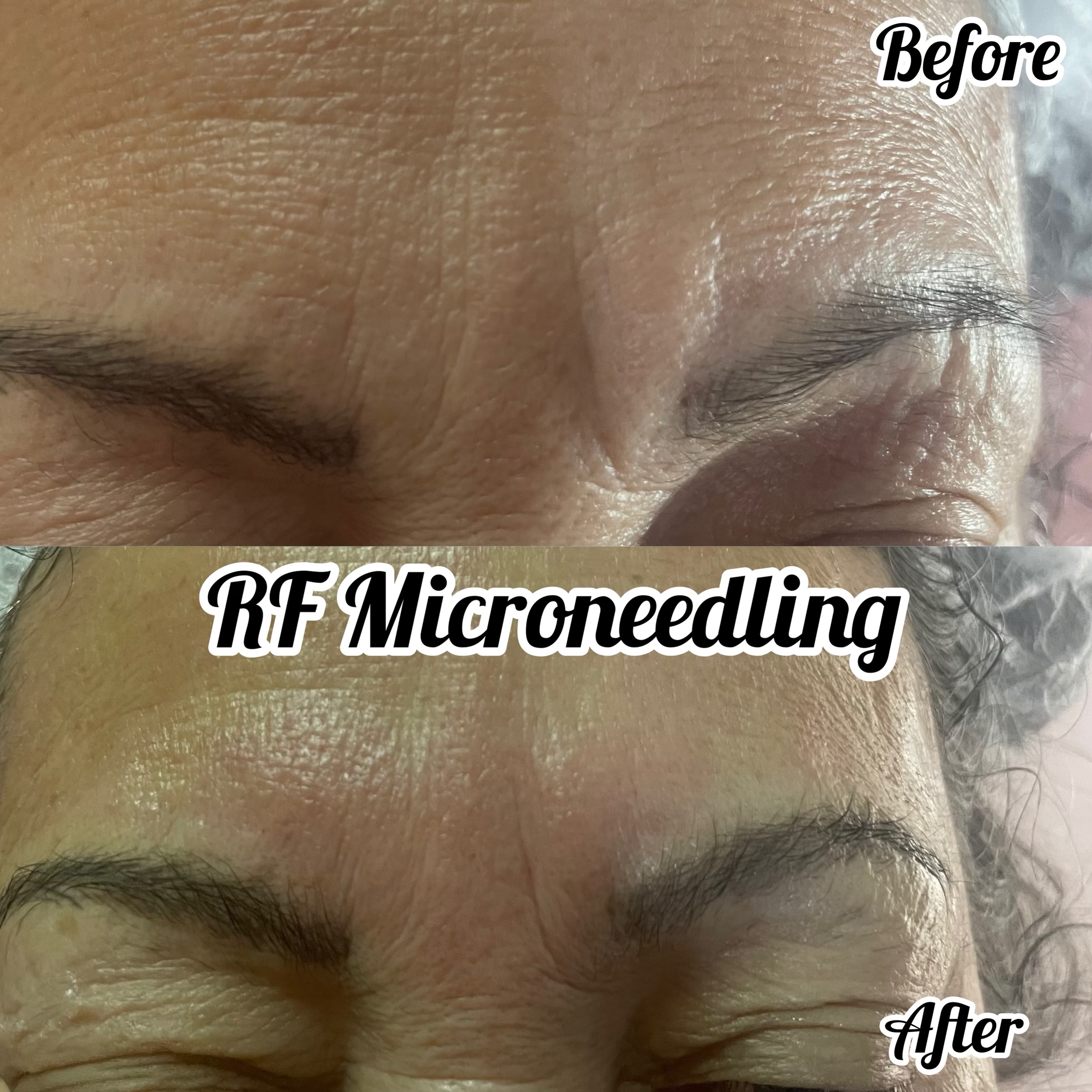 rf microneedling before and after march 2023