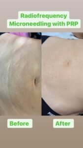 RF Microneedling Amazing Results