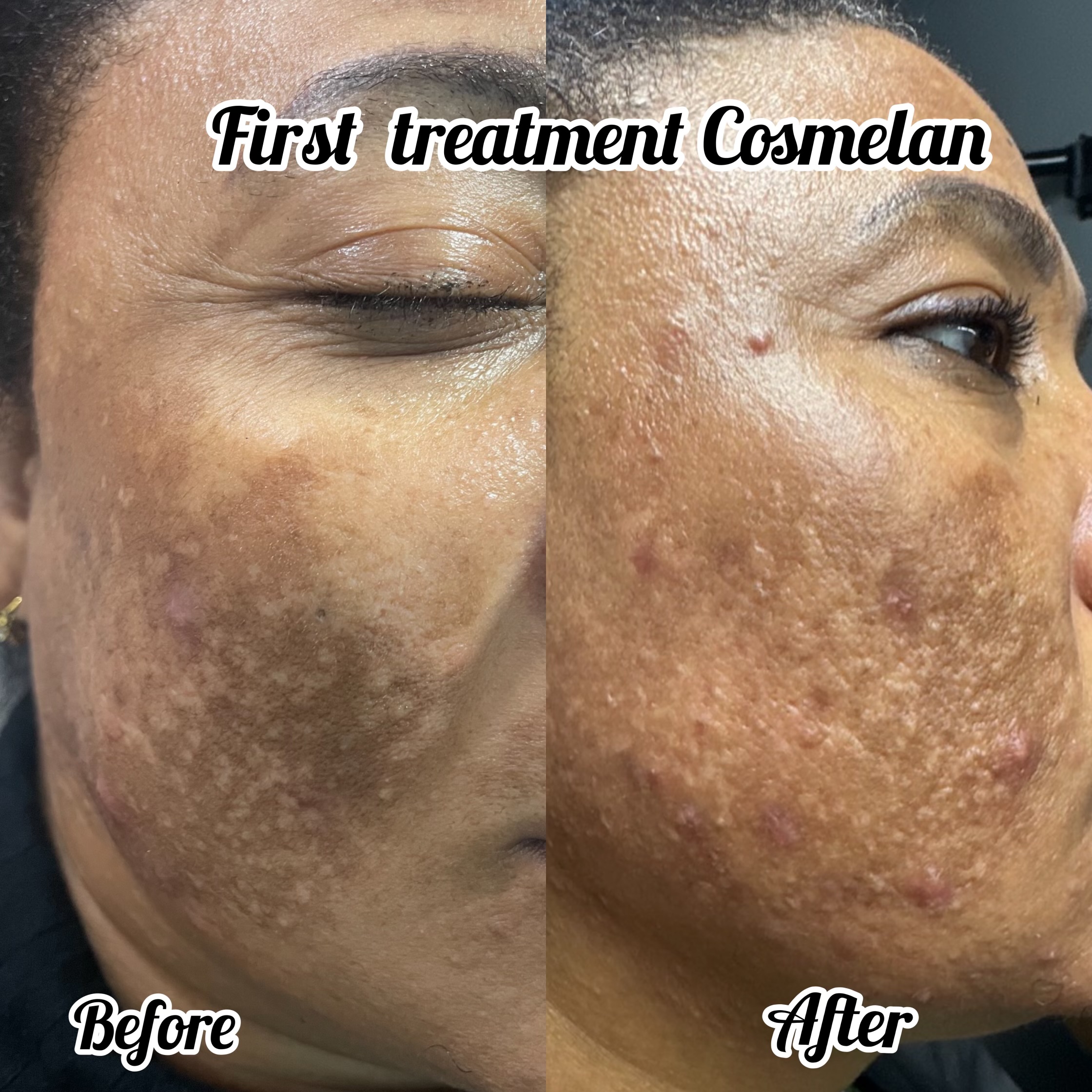 Cosmelan Facial Peel