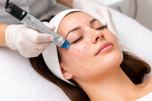 Hydrafacials calming acne-prone skin and reducing visible redness.