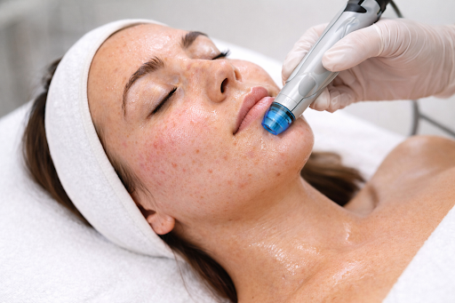 Hydrafacials improving skin texture on oily and acne-prone skin.