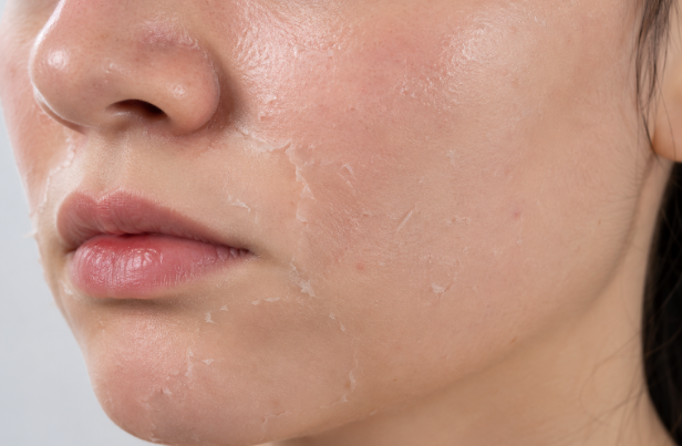 IMAGE Perfection Lift peel recovery with mild facial peeling.